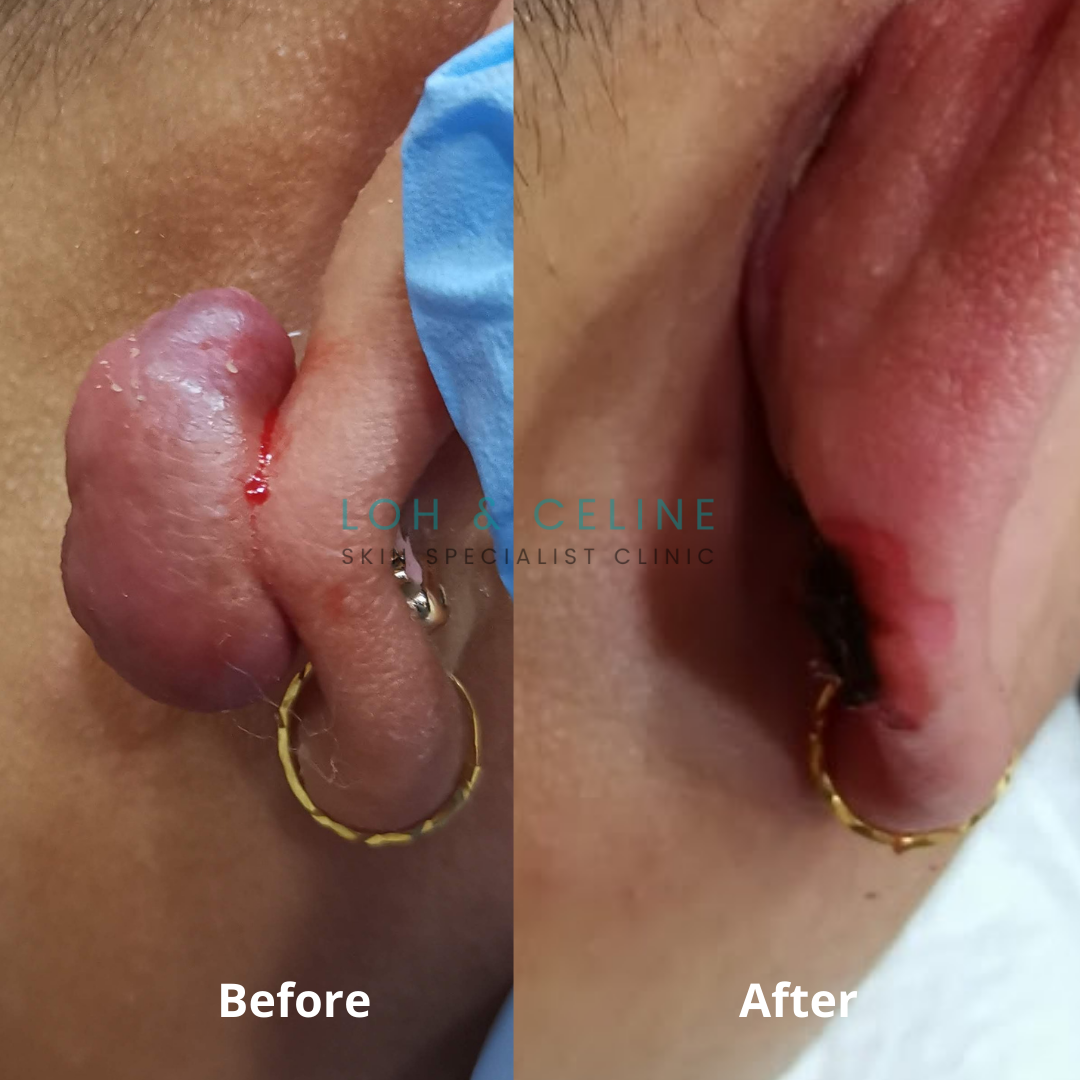 Before and after ear keloid removal