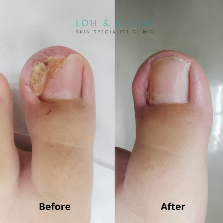 Nail before & after