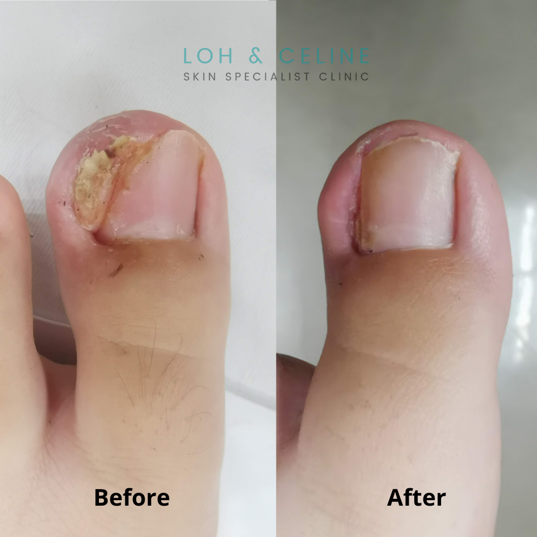 Before and after nail treatment