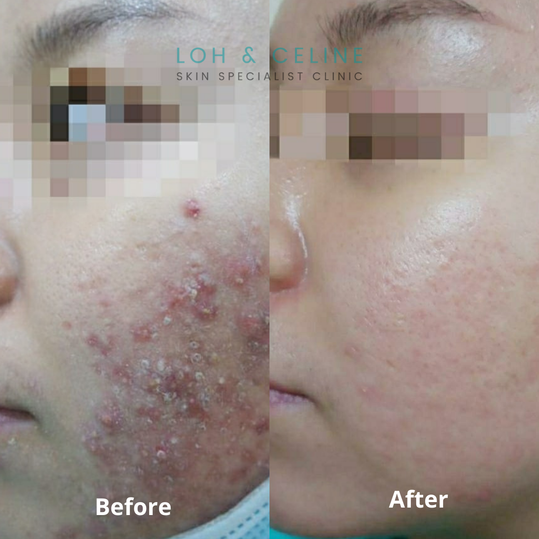 Before and after acne treatment