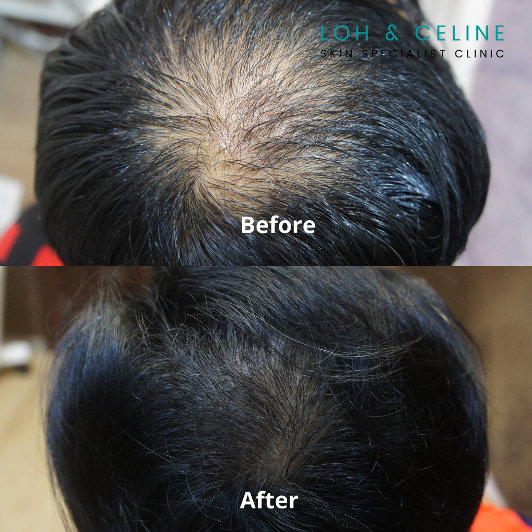 Hair loss treatment before and after in Alor Setar, Kedah