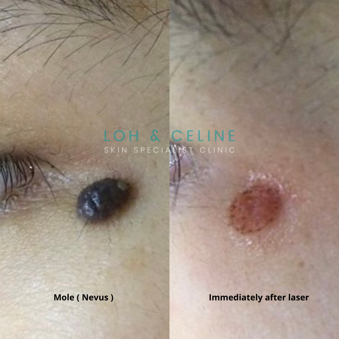 Before and after mole removal