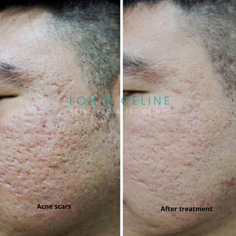 acne scars