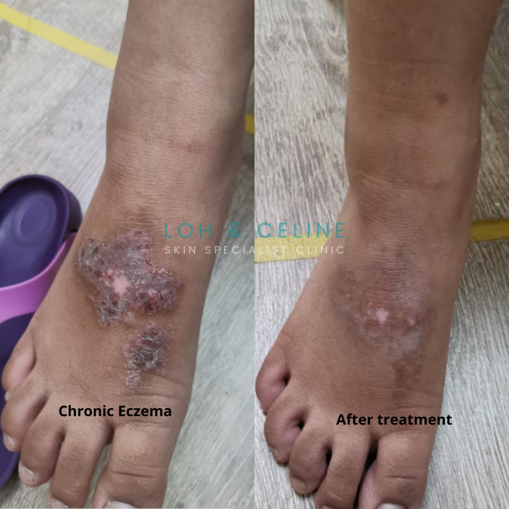 Shoe allergy. the lesion healed well with proper skin specialist treatment.