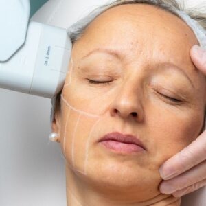 HIFU aesthetic treatment performed by an LCP-certified doctor in Alor Setar, Malaysia