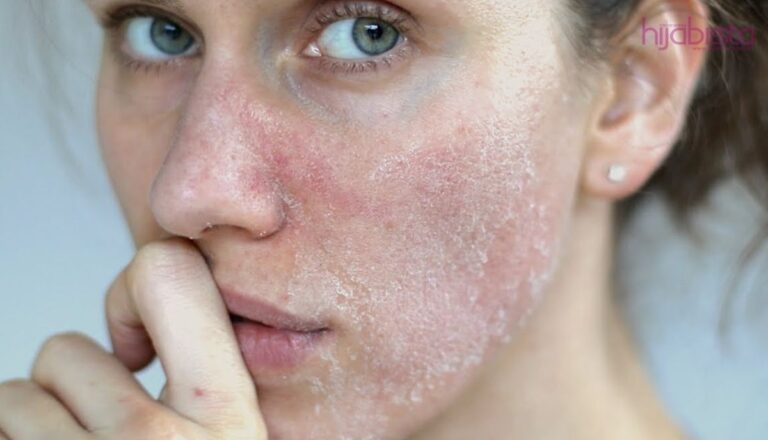 Topical Steroid Withdrawal treatment - dry, red inflamed skin eczema - Kedah dermatologist