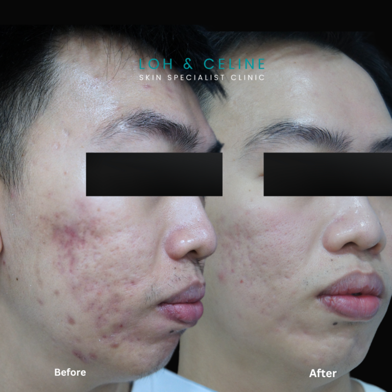 Before and after Slyfirm X RF Microneedling treatment for acne scars at Loh & Celine Skin Specialist Clinic in Alor Setar, Kedah