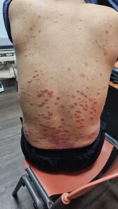 Pakar Kulit Psoriasis Kedah
