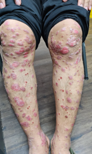 Pakar Kulit Psoriasis