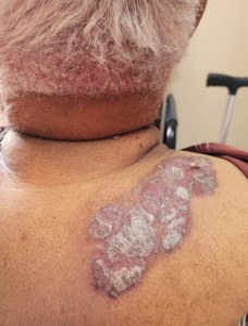 Biologic psoriasis