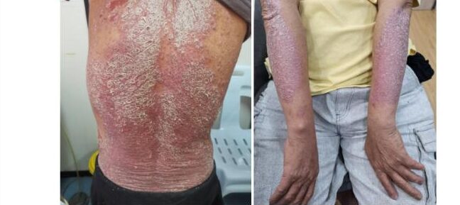 Psoriasis patches with thick, silvery scales on the back and forearm
