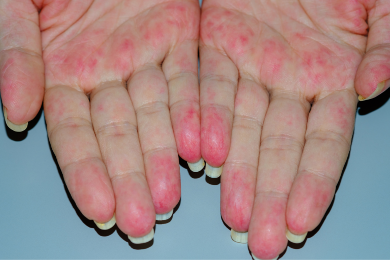 Redness and skin changes around the fingertips caused by an autoimmune skin condition