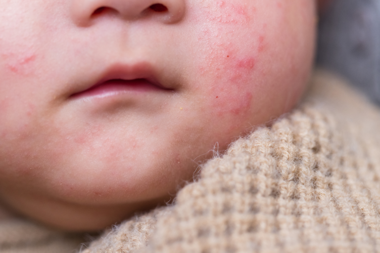 Skin condition on a child's cheek before gentle dermatologist treatment