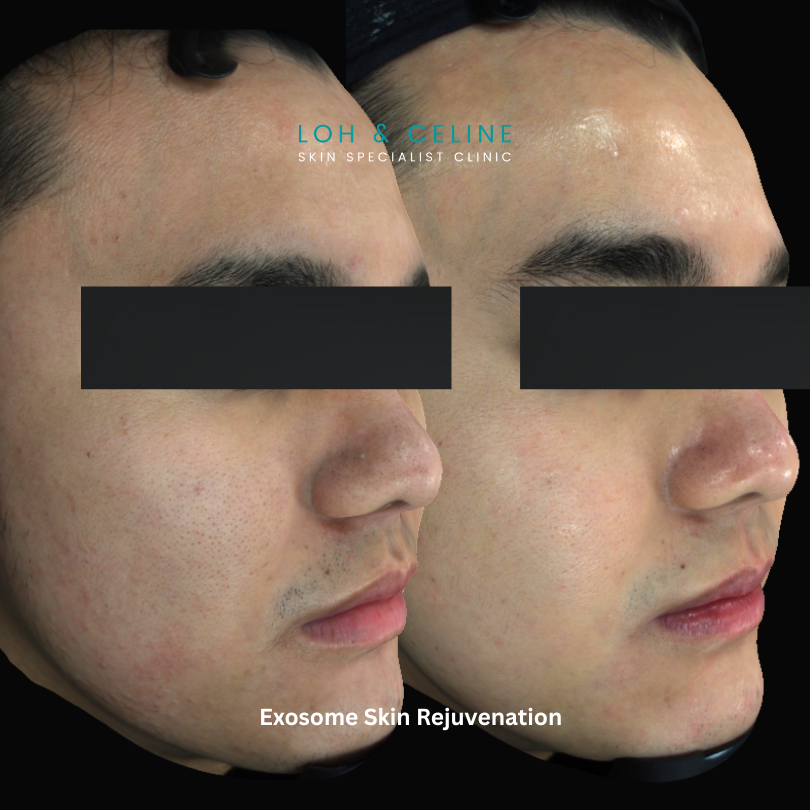 Exosome skin treatment before and after – Alor Setar, Kedah Exosome skin treatment before and after results for skin regeneration and texture at Loh & Celine Skin Specialist Clinic, Alor Setar, Kedah