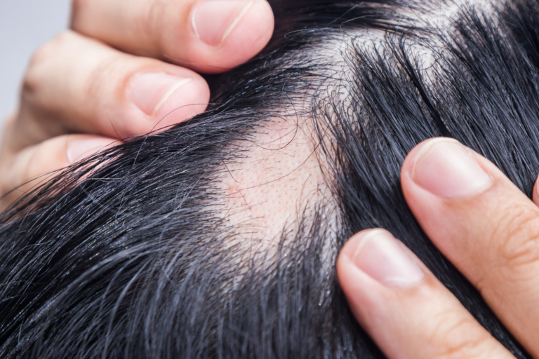 Hair thinning and scalp hair loss examined by parting the hair, before dermatologist treatment