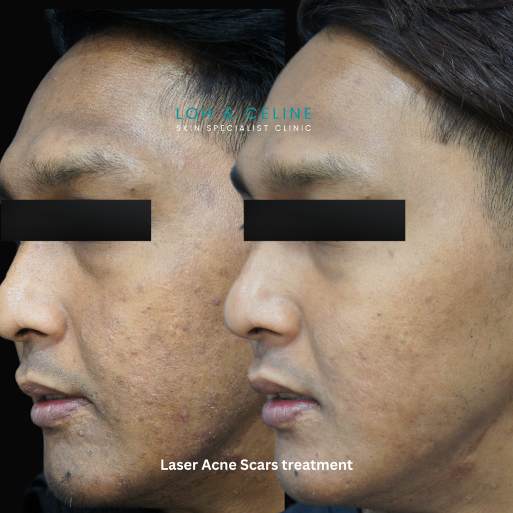 Laser acne scars treatment before and after results at Loh & Celine Skin Specialist Clinic in Alor Setar, Kedah, showing smoother skin with reduced acne scarring on a patient's cheek and jaw