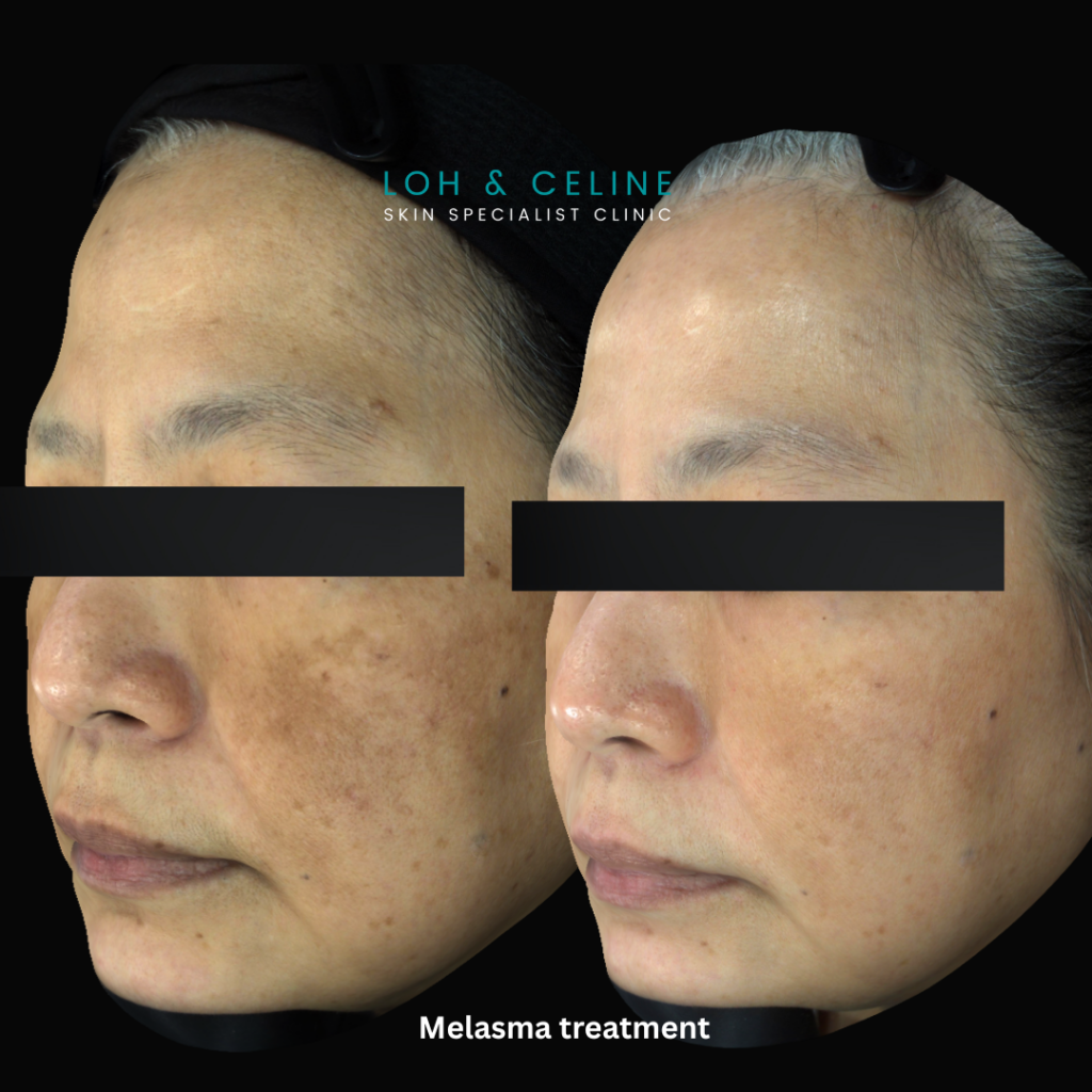 Melasma treatment before and after results at Loh & Celine Skin Specialist Clinic in Alor Setar, Kedah, showing reduced facial pigmentation and dark patches on a patient's cheeks