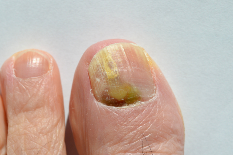 Fungal nail infection (onychomycosis) causing a yellow, thickened toenail before treatment