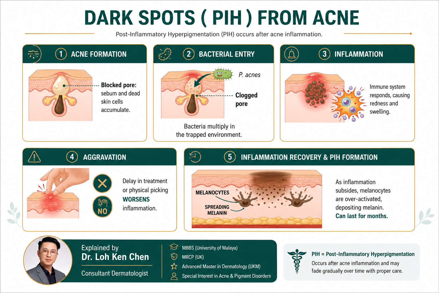 Contoh PIH (hiperpigmentasi pasca inflamasi) daripada jerawat