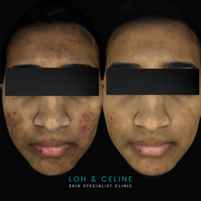 Before and after post-acne hyperpigmentation (PIH) treatment