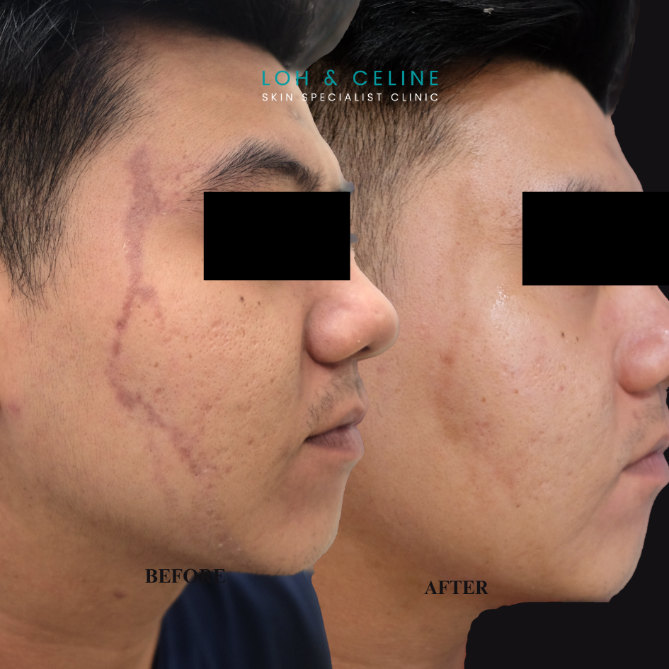 Before and after post-inflammatory hyperpigmentation from insect bite