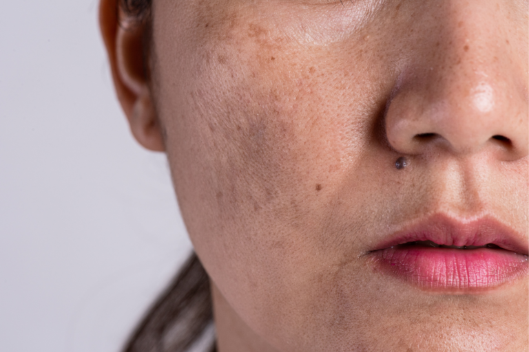Facial pigmentation and dark spots on the cheek and jawline before treatment