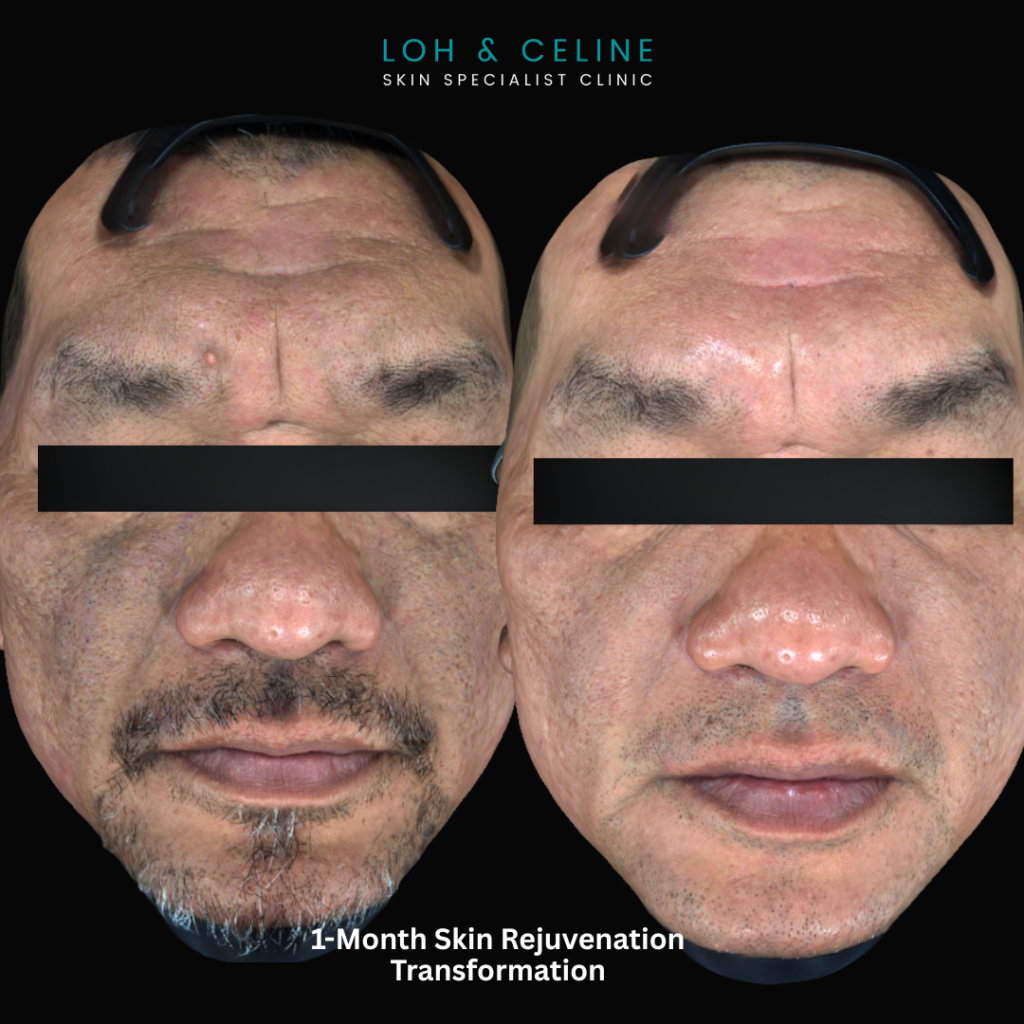 PDRN rejuvenation in ALor Setar, Kedah
