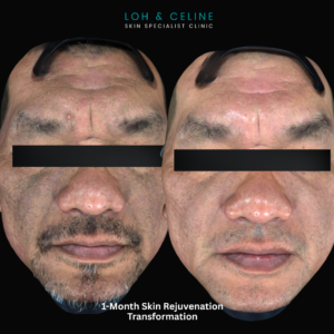 PDRN rejuvenation in ALor Setar, Kedah