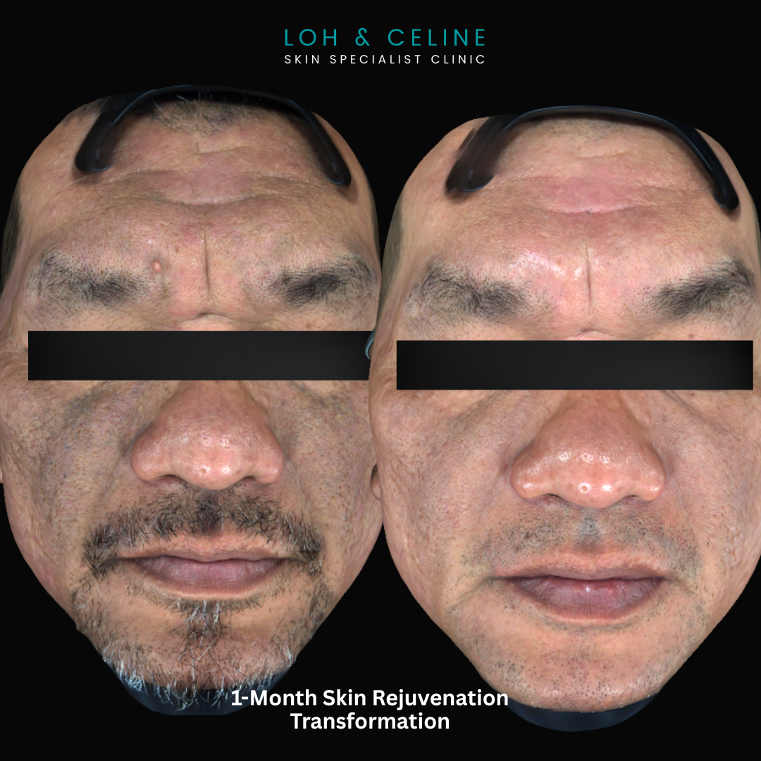 PDRN Plenhyage skin booster before and after – Alor Setar, Kedah PDRN Plenhyage polynucleotide skin booster before and after results at Loh & Celine Skin Specialist Clinic, Alor Setar, Kedah