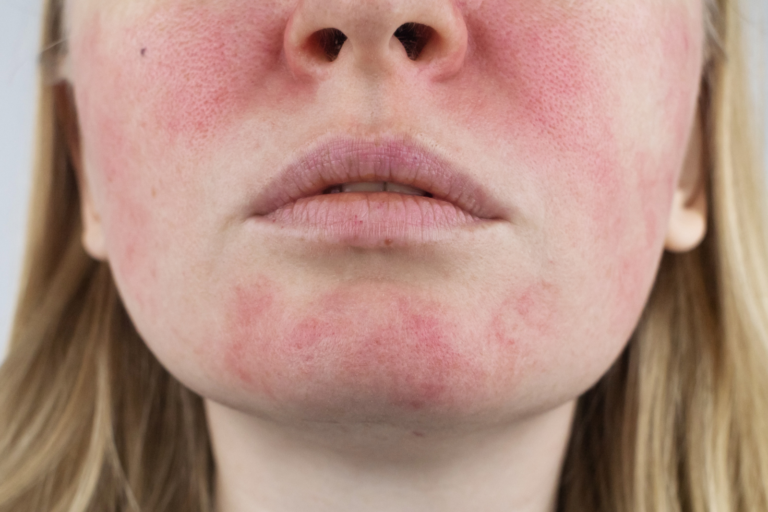 Close-up of facial rosacea with redness and flushing on the cheeks and chin before treatment in Alor Setar