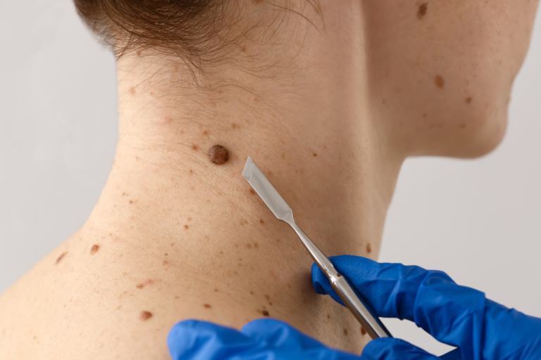 Dermatologist examining moles on the neck and shoulder for skin cancer screening