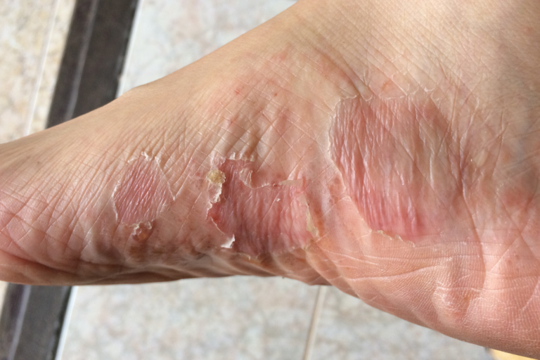 Bacterial skin infection on the foot before dermatologist treatment