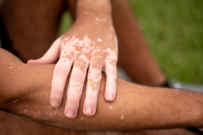 Vitiligo depigmentation patches on the hand and wrist before dermatology treatment