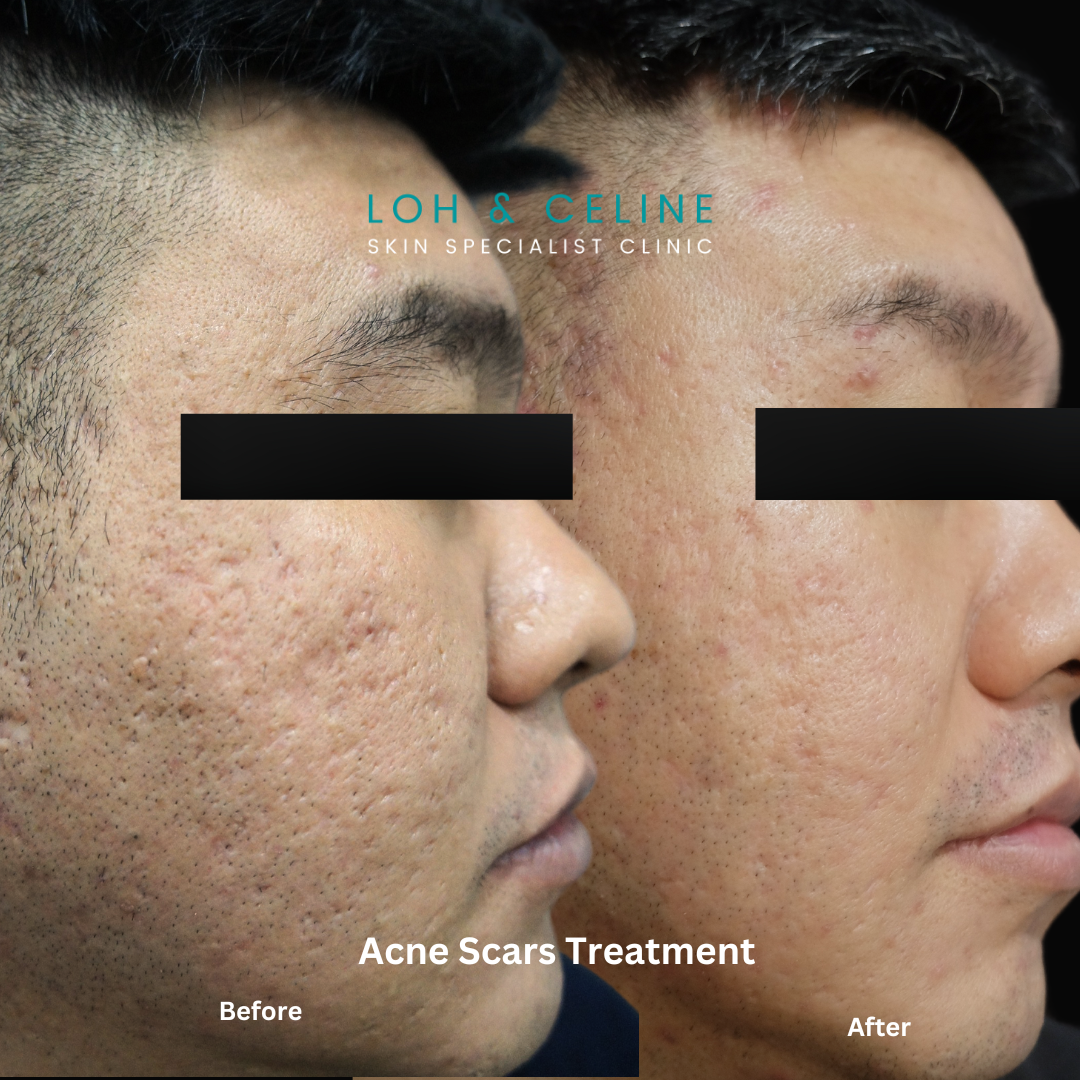 Juvelook PDLLA acne scars before and after – Alor Setar, Kedah Juvelook PDLLA collagen biostimulator acne scars before and after results at Loh & Celine Skin Specialist Clinic, Alor Setar, Kedah