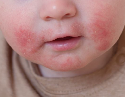 Atopic dermatitis eczema on a child’s face treated by a dermatologist in Alor Setar, Kedah