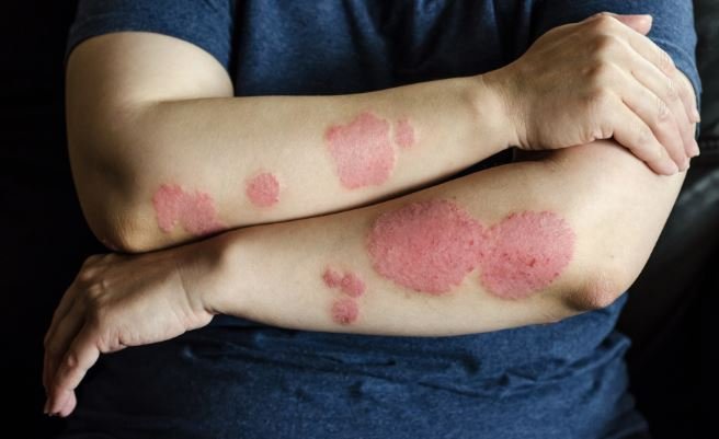 Plaque psoriasis with red, silvery-scaled patches on both forearms