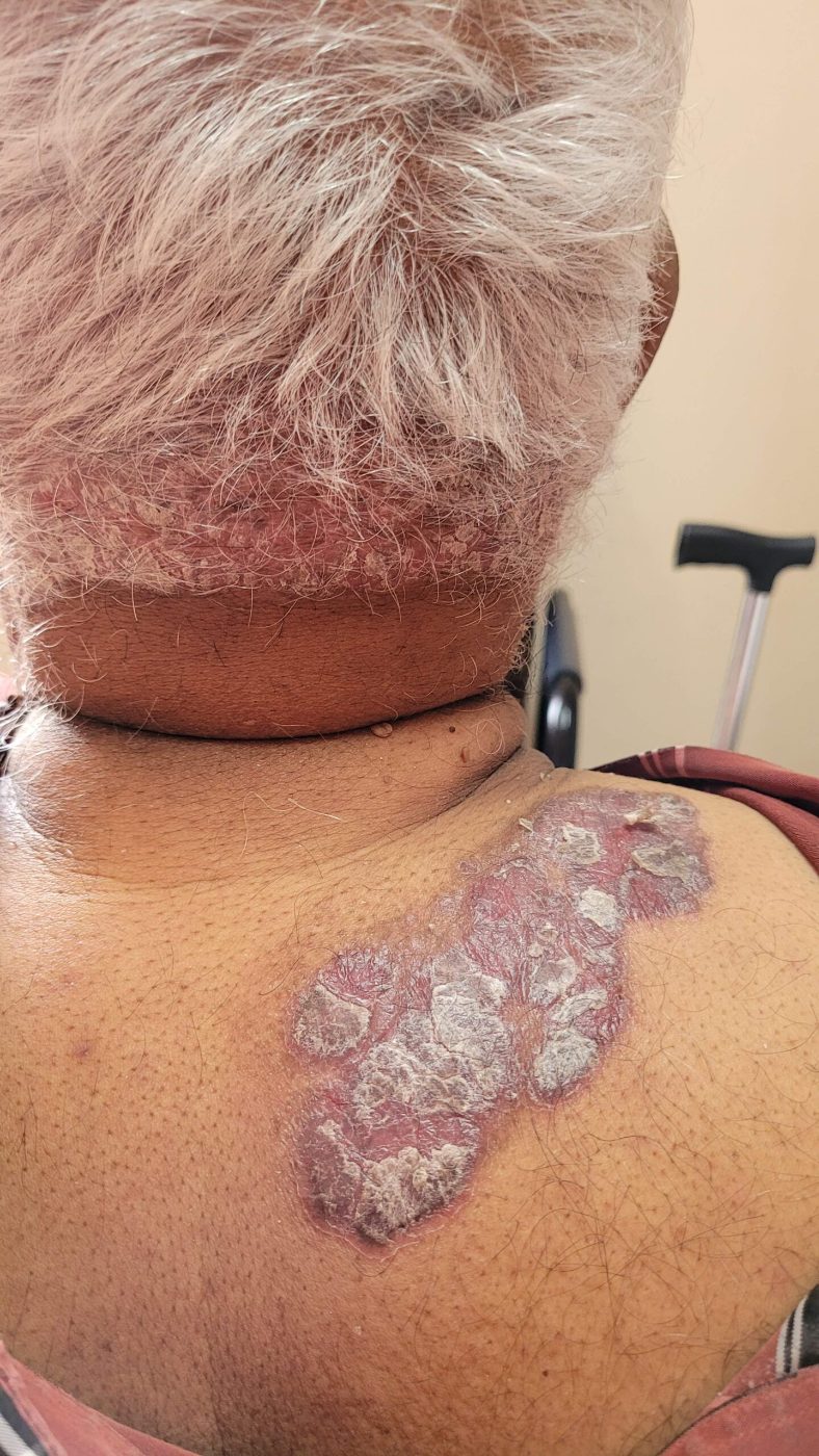 Thick psoriasis plaque on the nape and upper back