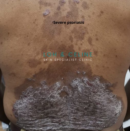 Silvery, scaly psoriasis plaques on a patient's lower back