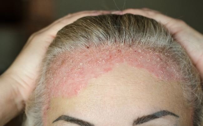 Scalp psoriasis with red plaques and scale along the frontal hairline