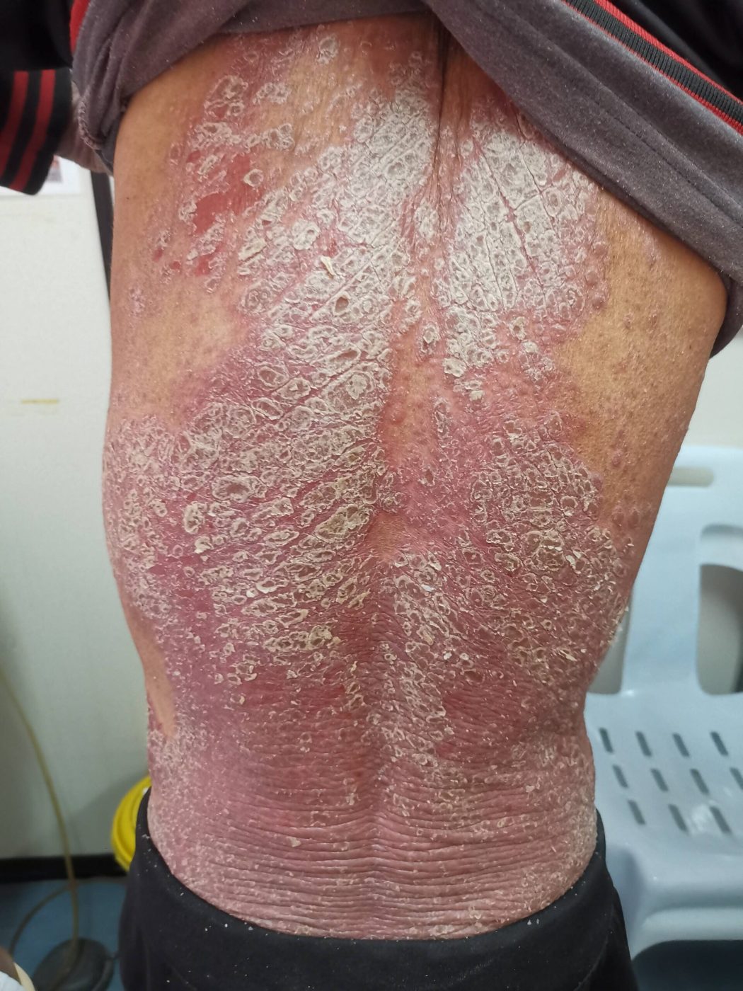Severe plaque psoriasis covering the back with thick silvery scale