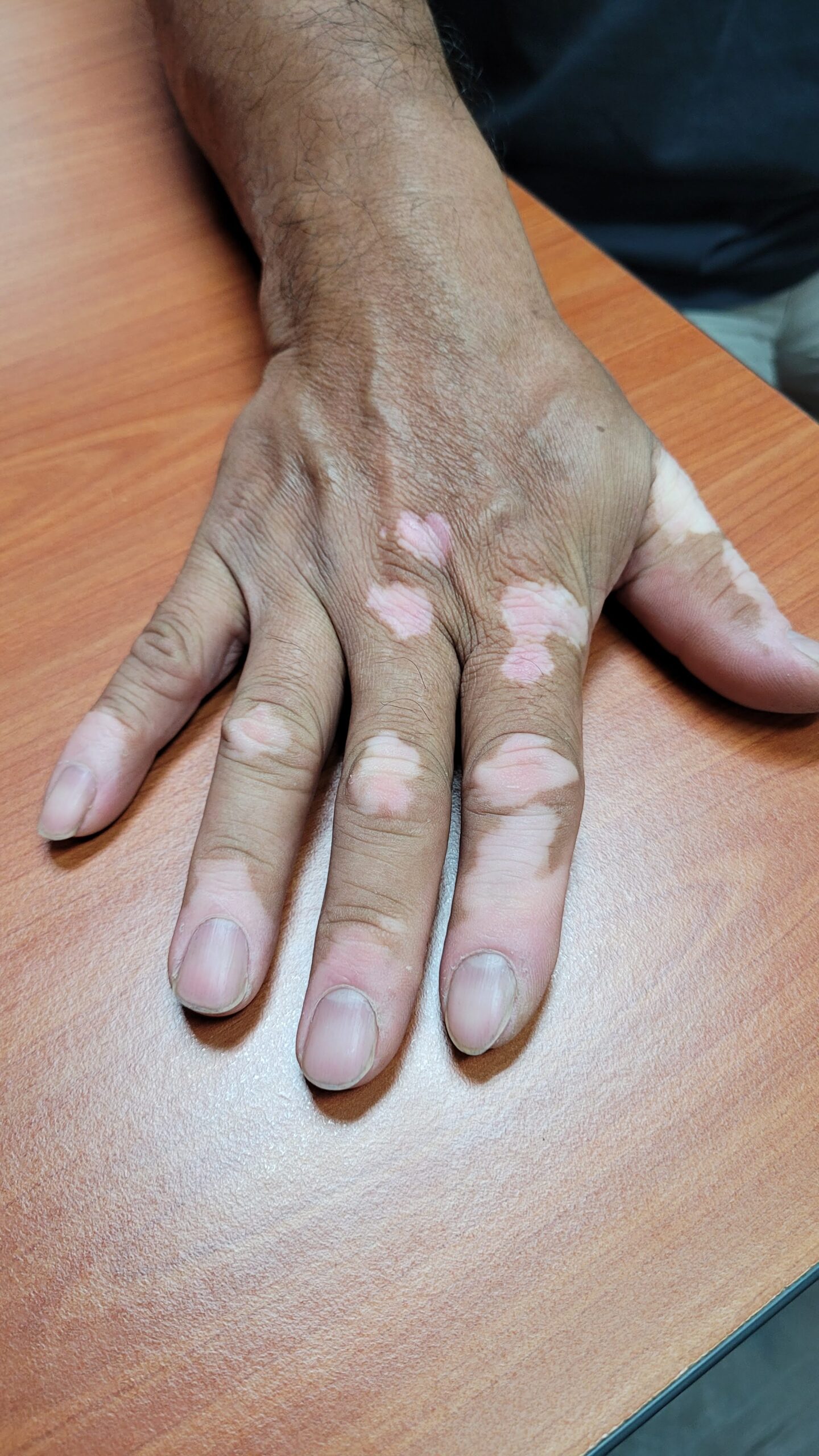 Vitiligo white patches on the fingers and back of the hand; hands respond more slowly to ruxolitinib cream for vitiligo than the face