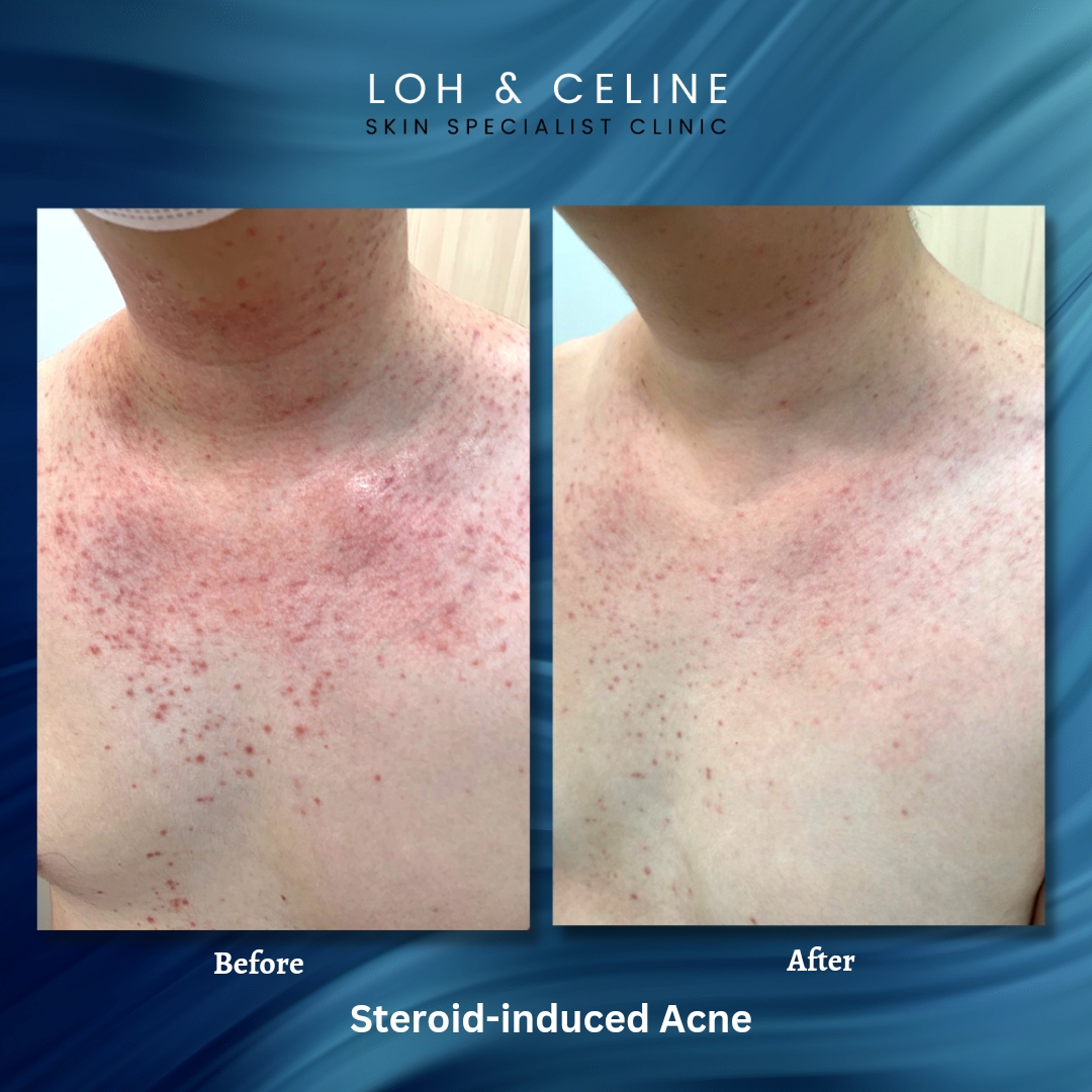 Before and after steroid-induced acne treatment