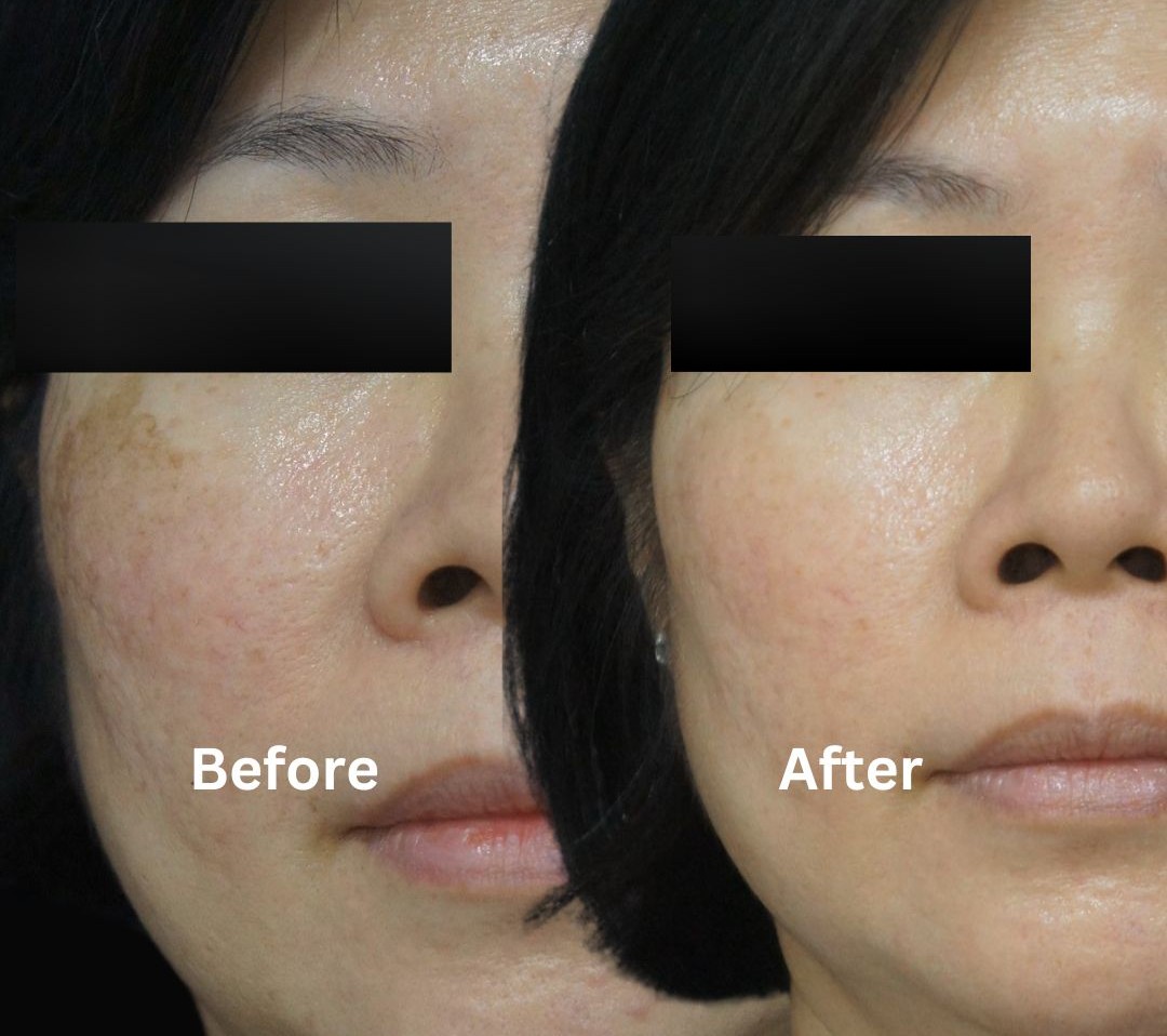 Dermatologist-led pigmentation assessment and Pico Laser treatment in Alor Setar