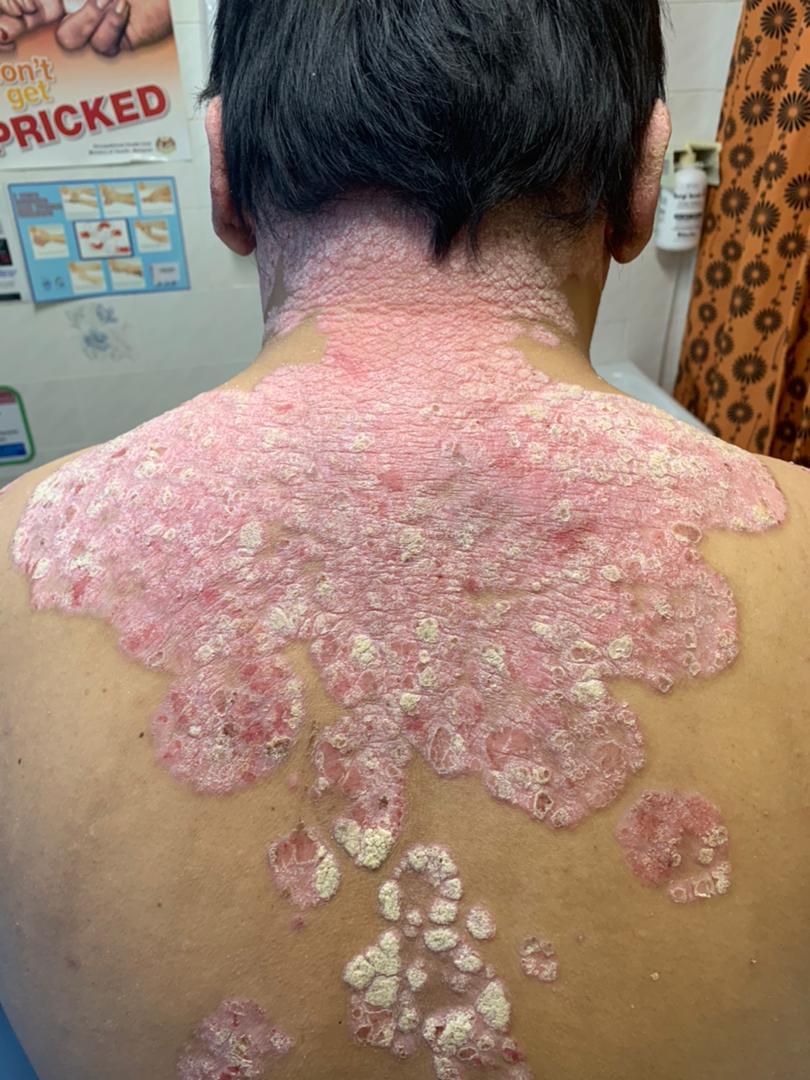 Psoriasis plaques on the back and body assessed by a dermatologist in Alor Setar