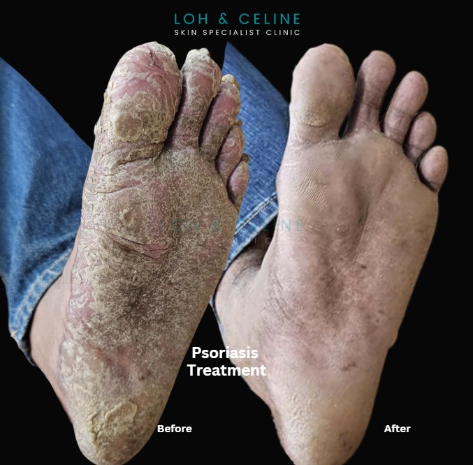 Before and after psoriasis treatment