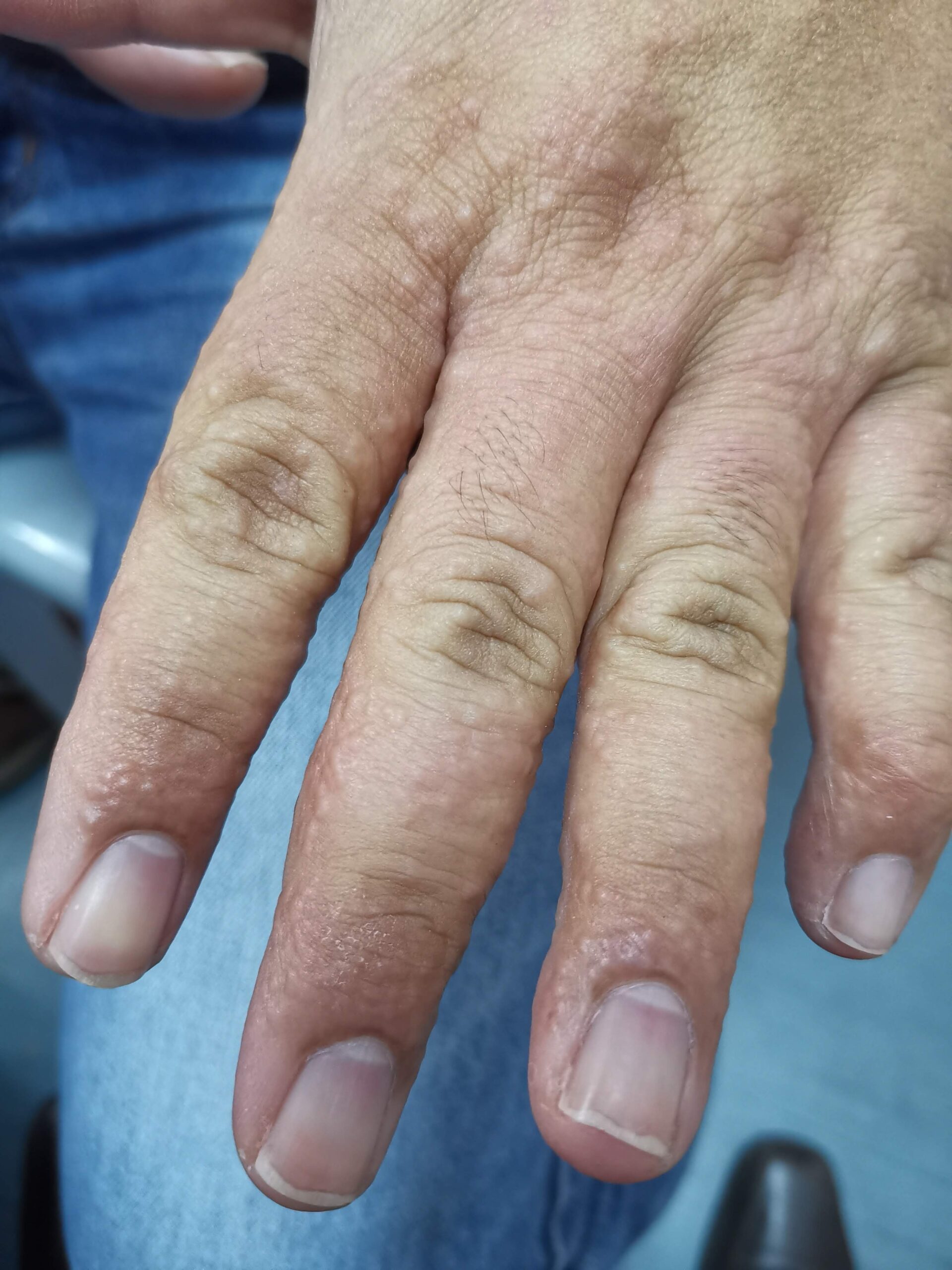 Hand eczema (pompholyx) treatment by dermatologist in Alor Setar
