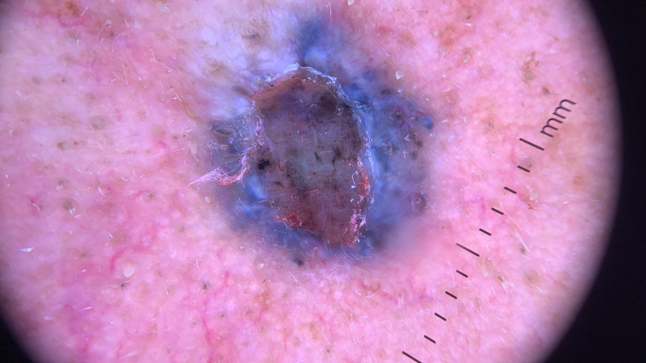 Close-up view of a changing skin lesion being examined with dermoscopy