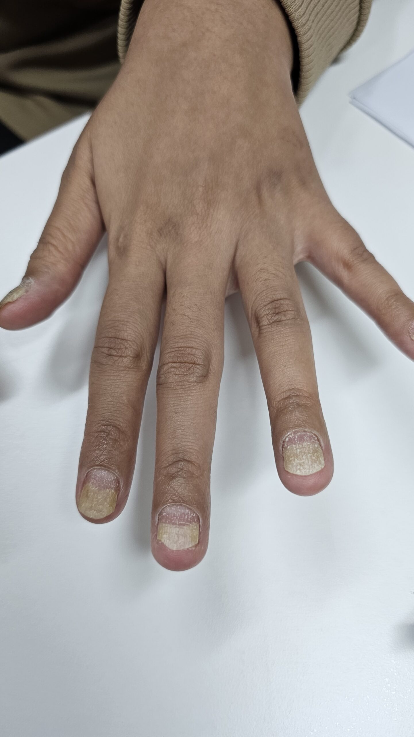 Sandpaper nail (nail psoriasis) assessed by dermatologist in Alor Setar