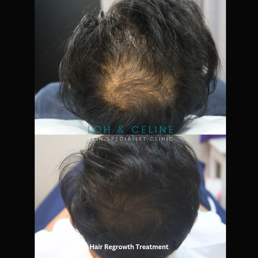 Before and after photos showing thicker, fuller hair following hair loss treatment