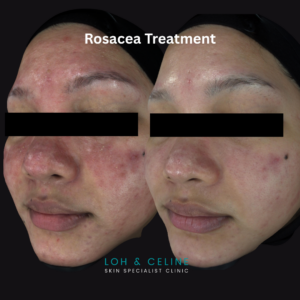 Before and after rosacea treatment showing reduced facial redness and inflammatory bumps